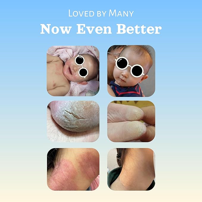 Natural SKIN REPAIR. Clinically tested Aromatherapy. Powerful Essential Oil. Eczema, Dermatitis, Diaper rash, and Sensitive skin. For all skin types. Hypoallergenic, Vegan, Paraben Free. 50ml bottle